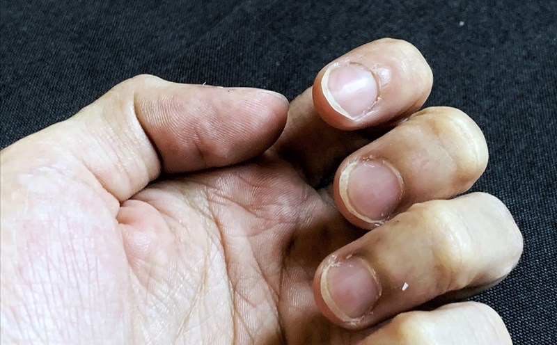 Những bệnh lý da thường gặp ở thợ nail – Nguyên nhân, cách chữa và phòng tránh