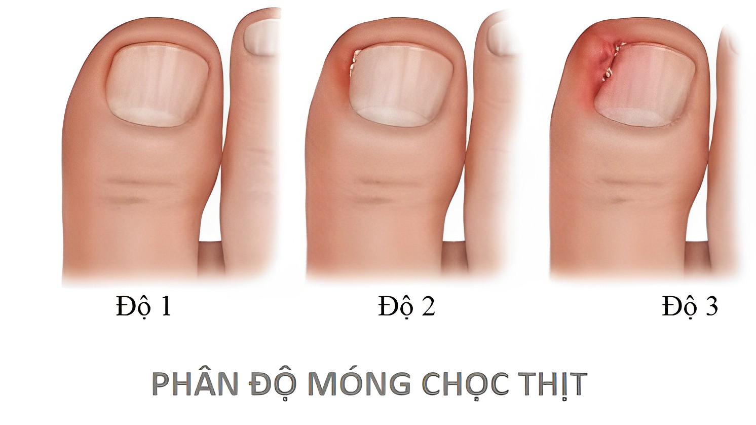 Móng chọc thịt – Viêm da quanh móng: Nguyên nhân, cách phòng và điều trị